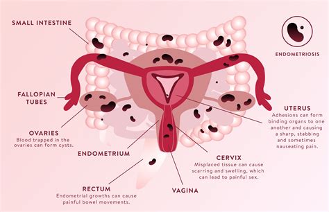Pelvic adhesions are scar tissue. . Bowel stuck to uterus symptoms